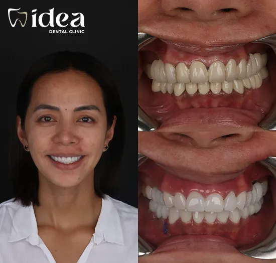 Before & After 11