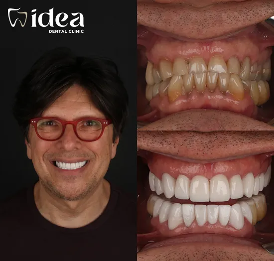Before & After 5
