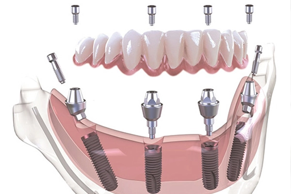 All-on-4 Implants