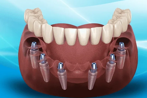 All-on-6 Implants