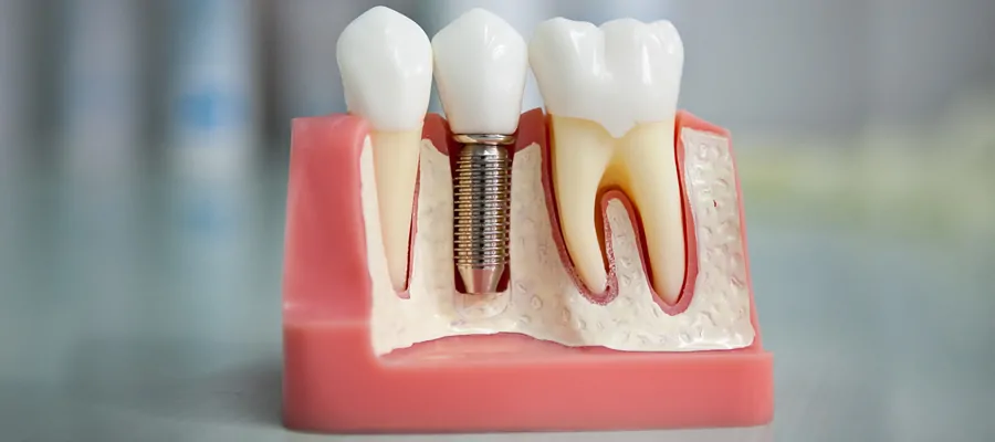 Dental Implants Turkey