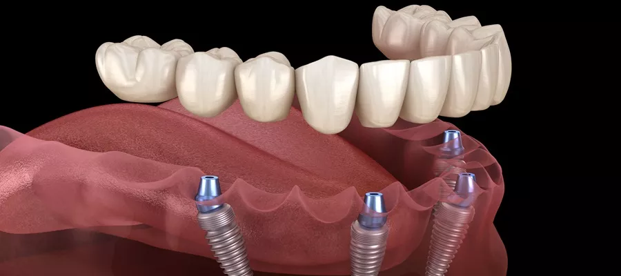 Implants Dentaires Bouche Complète