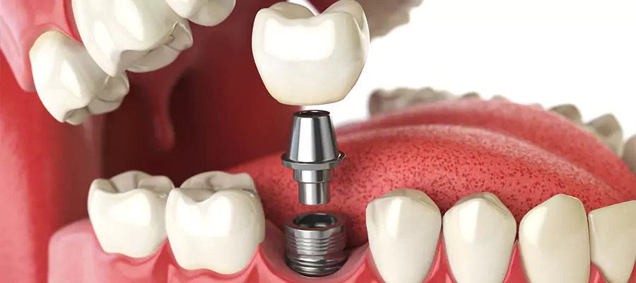 İmplant Teadavisi İstanbul, İmplant Fiyatları | İdea Dental Clinic