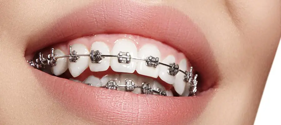 Orthodontic Treatment